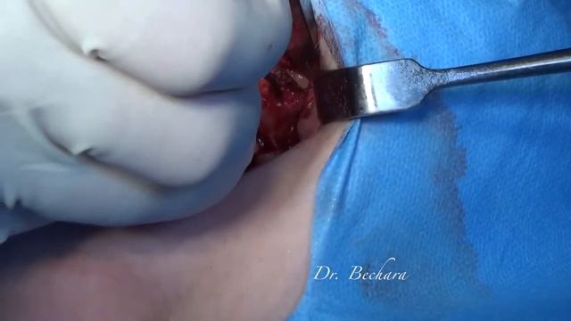 MIR KLINIKA UPPER JAW RIDGE SPLIT + SINUS LIFT BY DR BECHARA смотреть онлайн