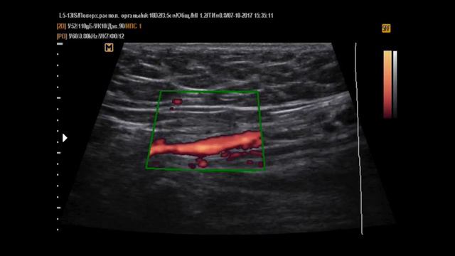 Фуникулоцеле 2 7-10-17