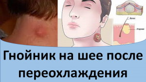 Гнойник на шее после переохлаждения