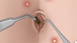Is Your Belly Button Clean? ASMR Remove Navel Stone Animation | Meng's Stop Motion