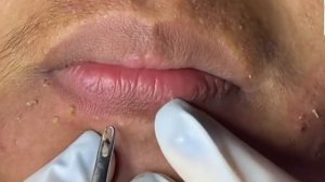 Remoção de cravo 2021 - Pimple Popping 2021 -Blackhead Removal  EP0010