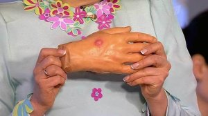 Летние боли. Укус комара. Жить здорово! Фрагмент выпуска от 05.06.2015