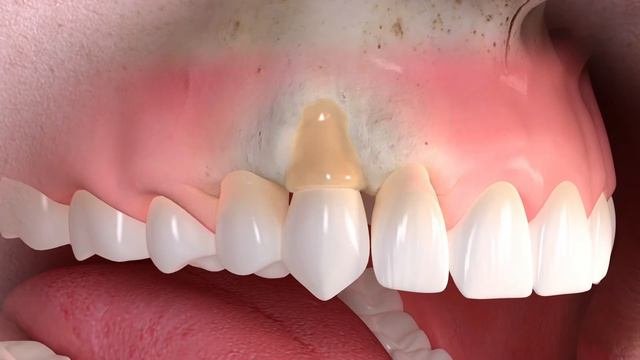 Что такое рецессия десны и как происходит лечение