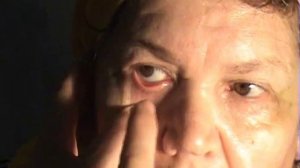 Наружный осмотр глаза и его придатков