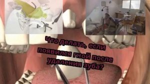 Что делать, если появился гной после удаления зуба?