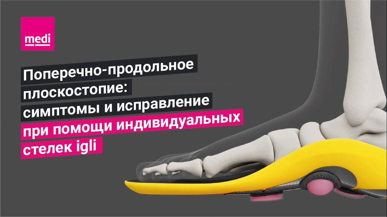 Поперечно-продольное плоскостопие: симптомы и исправление при помощи индивидуальных стелек Igli