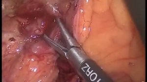 Lap Left Colectomy