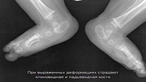 Варусная деформация нижних конечностей
