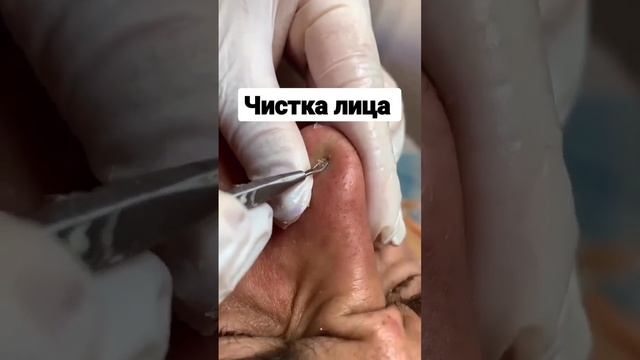 Чистка лица аппаратная чистка лица #beauty #facial #skiт#acne  #makeup #hairstyle #doctor #skincare