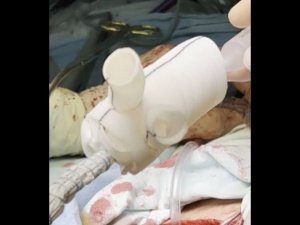 Протезирование дуги аорты гибридным протезом по авторской методике (для профессионалов)