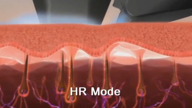 SOPRANO XL | лазерная эпиляция смотреть онлайн