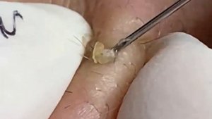 pimple,popper,extraction,blackhead,whitehead,milia,asmr,cyst