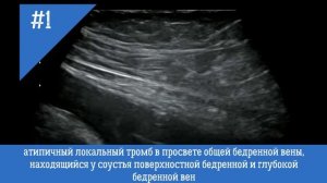 УЗИ сосудов. Атипичный локальный тромб в просвете общей бедренной вены