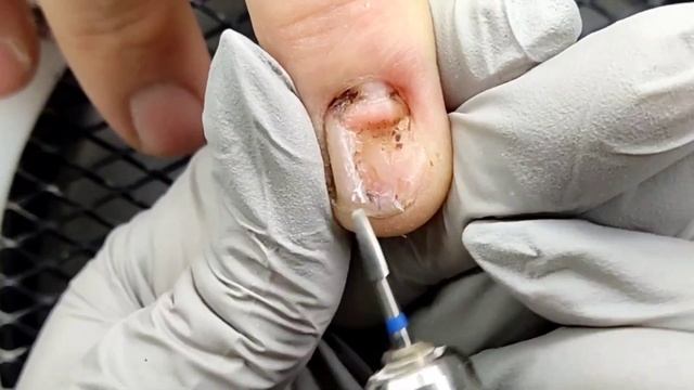 ?зачистка травматического онихолизиса