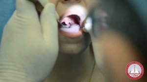 Задняя риноскопия