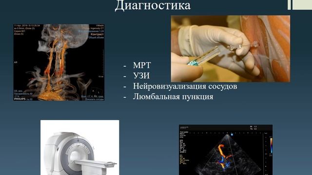 Синдромы поражения продолговатого мозга смотреть онлайн