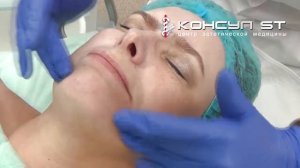 Феруловый пилинг в ЦЭМ "Консул СТ". Этапы процедуры