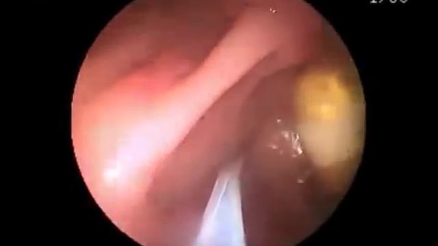 Капсульная эндоскопия  Удаление видеокапсулы/ Removing Videocapsule