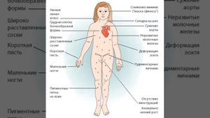 Синдром Шерешевского-Тернера. Причины патологии, диагностика, лечение.