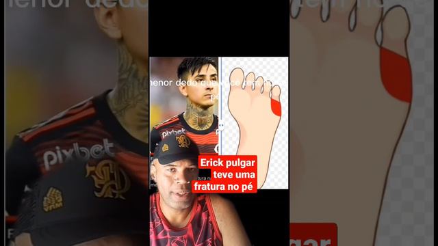 Erick pulgar teve uma fratura no dedo do pé #flamengo #erickpulgar #shortsviral #shortsyoutube