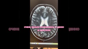 Лечим глиоз и очаги глиоза в головном мозге