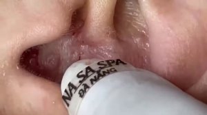 Прищи,Угри и прочии неприятности