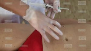 Мезодиссолюция (зона живота)