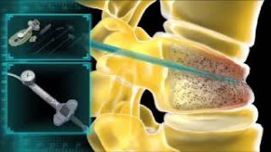 Кифопластика