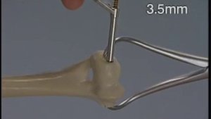 Внутрисуставной перелом мыщелка плечевой кости