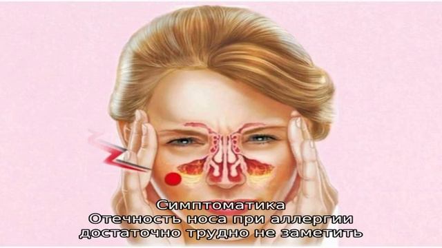 Как снять аллергический отек носа смотреть онлайн