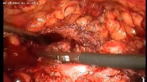 3Д лапаро.позадилонная аденомэктомия Millin 130 см3 за 42 мин, 3 D Laparo. retropubic adenomectomy