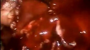 видеоряд карбункул