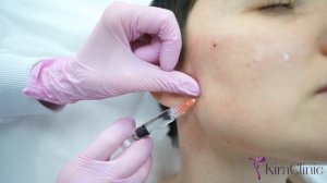 Процедура Профайло KiraClinic