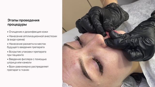 Контурная пластика лица | Мон плезир