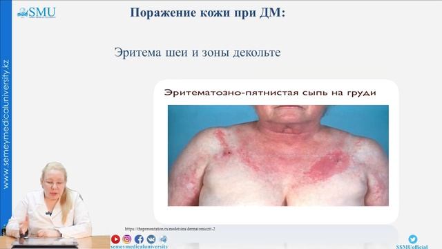 Дерматомиозит смотреть онлайн