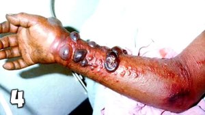 Как удалить клеща  Что Делать, если УКУСИЛ КЛЕЩ?