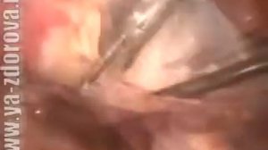 Надвлагалищная ампутация