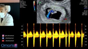 ULTRASSOM OBSTÉTRICO. Gestação inicial de 8 semanas.