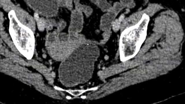 | GIT | Bowel tumors | Fake bowel lesion смотреть онлайн