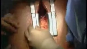 Торакотомия