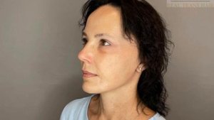 Смас - лифтинг подтяжка лица!