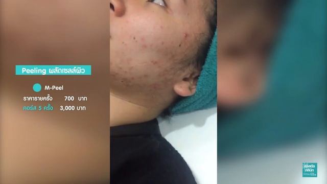 M-Peel | ลบรอยสิว ปรับผิวขาว | โดย คริสตัลคลินิก มหาสารคาม смотреть онлайн