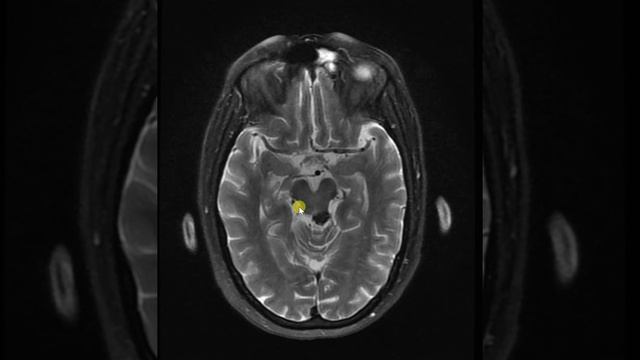 Quadrigeminal plate lipoma T1, T2 FS and FLAIR images