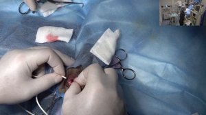 Гидроцефалия постановка шунта.