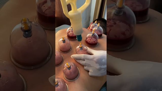 Hijama (cupping therapy)