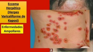 Herpes Simplex parte 2: Clínica