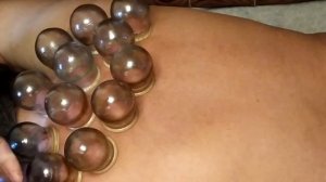 Ставим банки при простуде