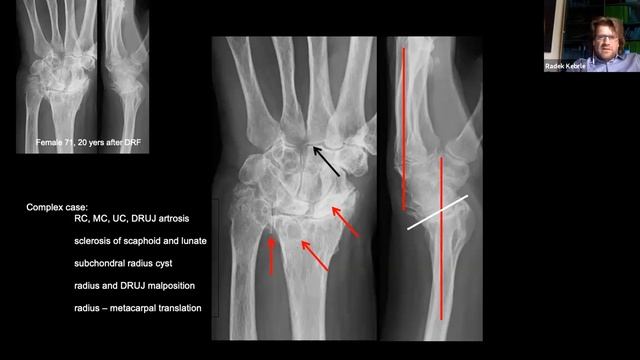 Medartis Solidarity Webinar - Radiocarpal fusion in deg. and posttraum. situations Dr. Radek Kebrl смотреть онлайн