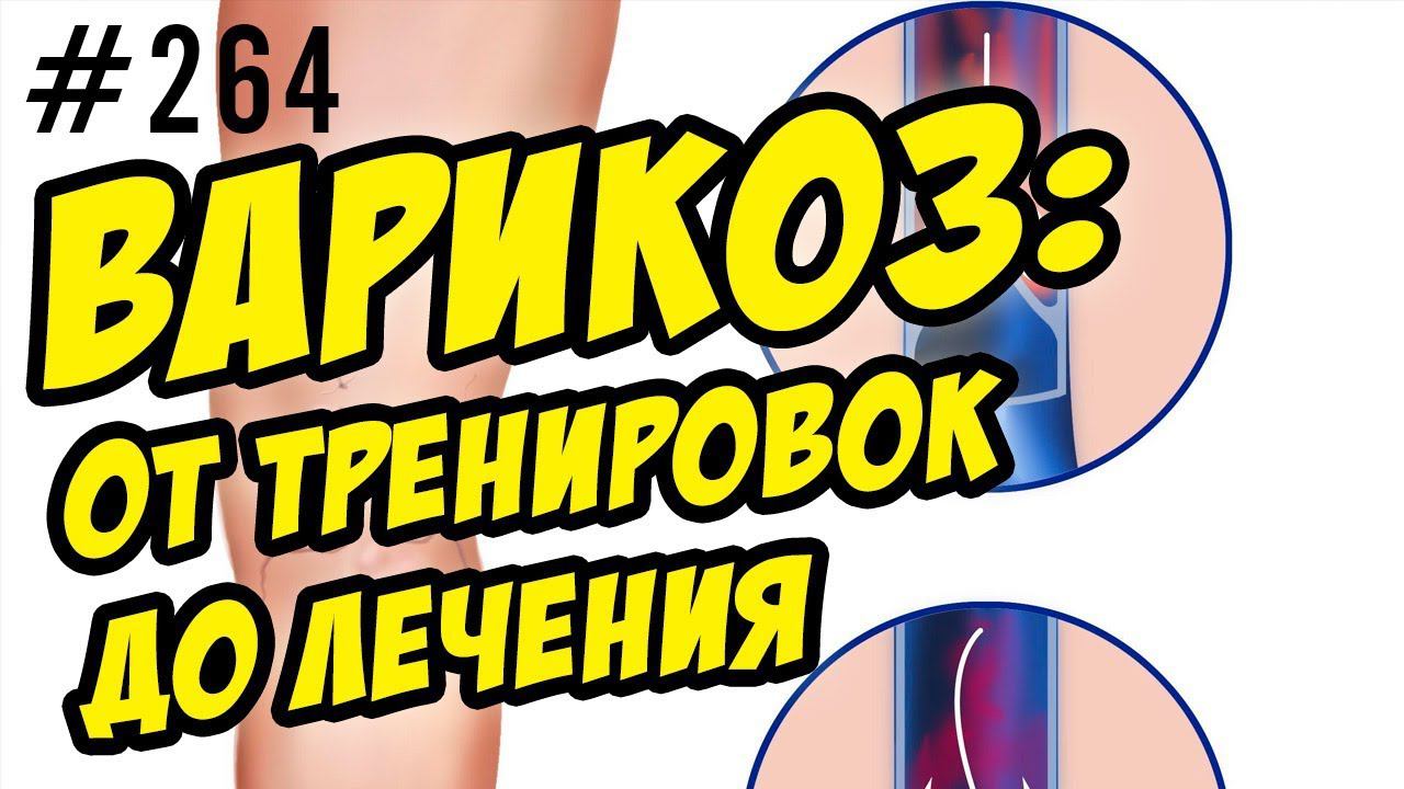 варикоз. варикоз и фитнес. причины и лечение варикоза. всё про варикоз