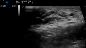 Образование в левой половине мошонки